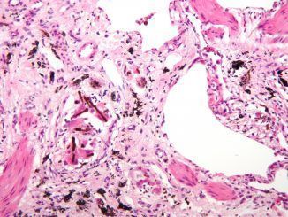 ¿Tienen los pacientes con asbestosis mayor riesgo de fallecer por covid?